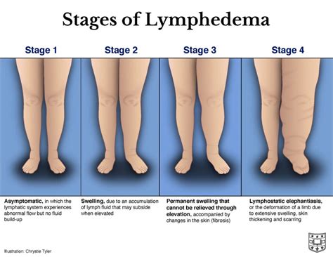 legs leaking fluid|Causes & Treatment – Lymphoedema / Oedema of。